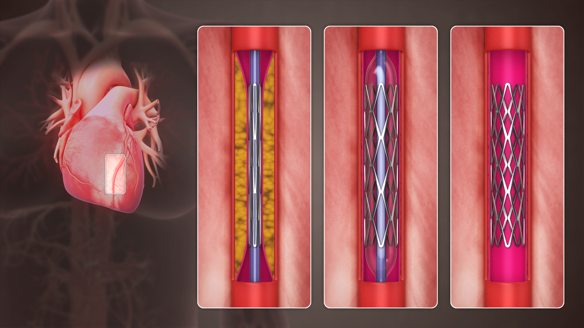 Medical illustration of a balloon catheter expanding a stent inside a narrowed coronary artery.